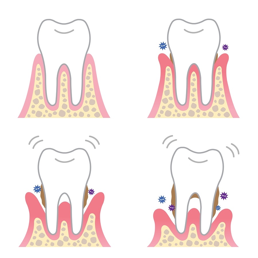 Gum disease treatment (parondontic)