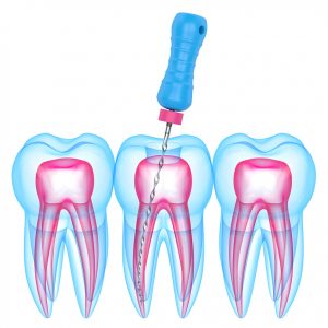 Traitement de canal (endodontie)