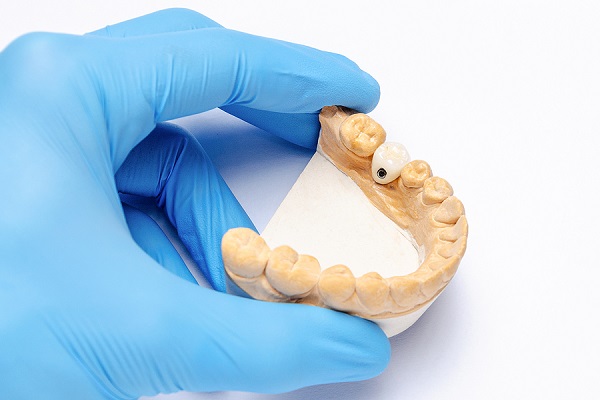Implant dentaire - SOS Sourire à Verdun
