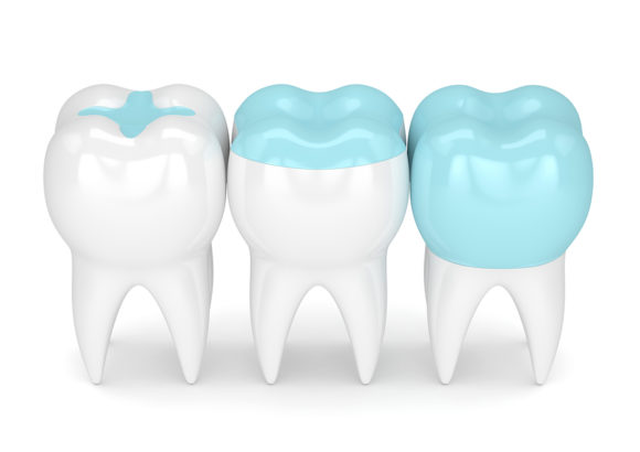 Dental inlays