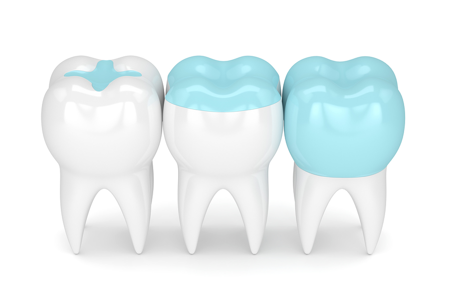 Dental inlays